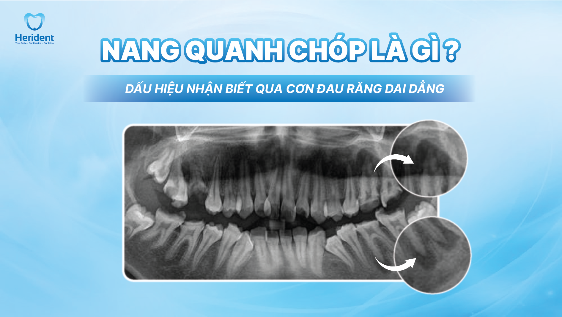 Nang quanh chóp là gì? Dấu hiệu nhận biết qua cơn đau răng dai dẳng